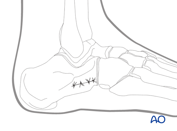 mio lateral approach to the calcaneus