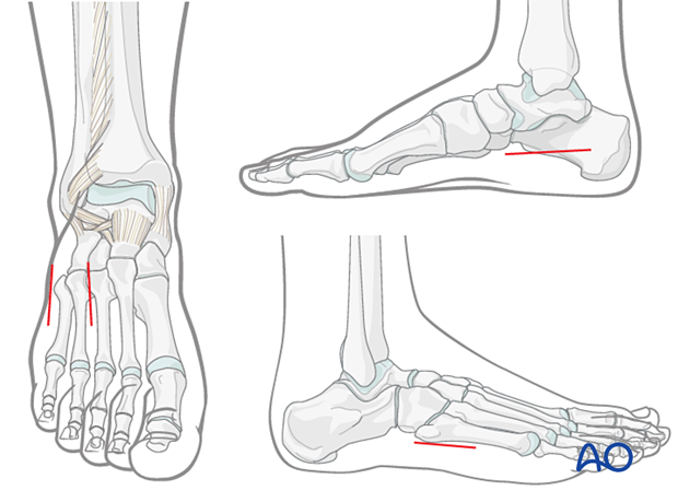 Releasing incision to treat foot compartment syndrome