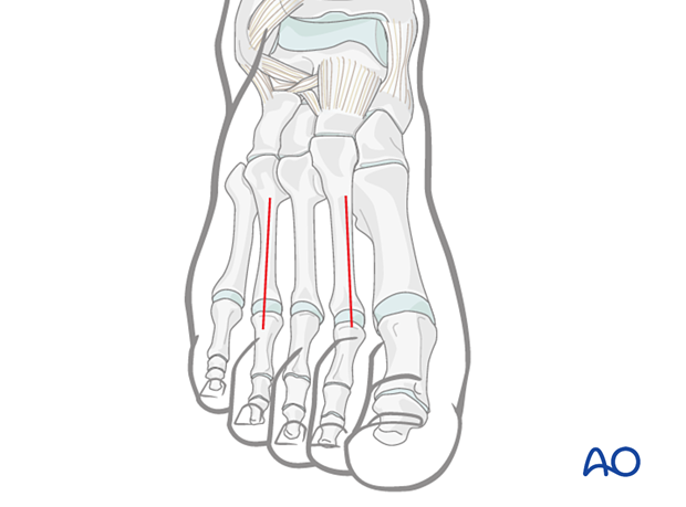 Double-dorsal incision to treat foot compartment syndrome