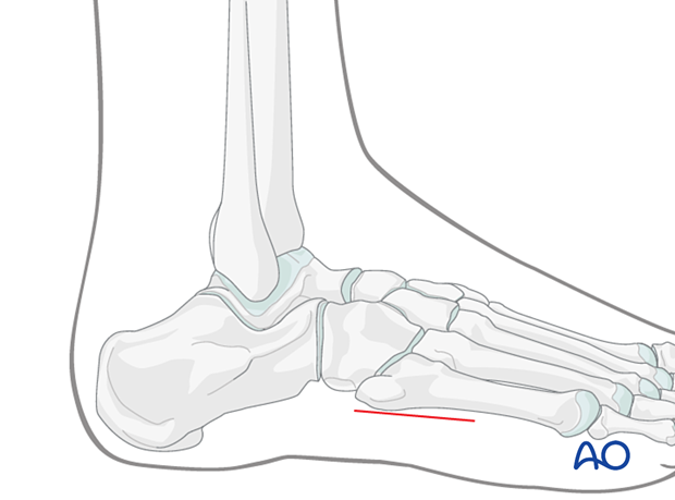 Lateral incision to treat foot compartment syndrome