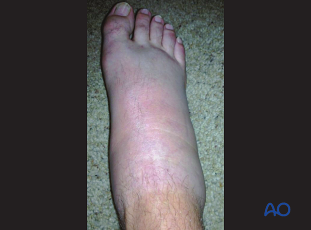 General swelling of the foot