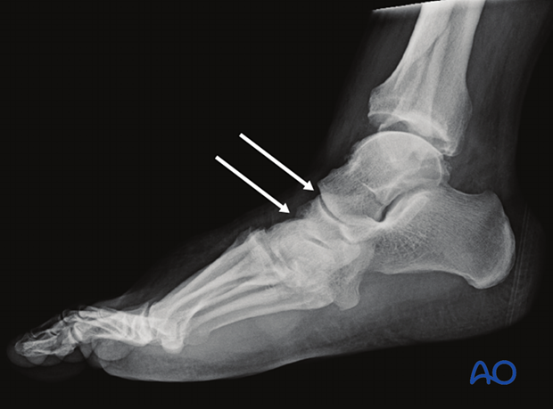 Lateral x-ray showing a step at Lisfranc and Chopart joint levels