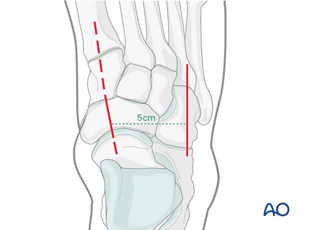 Combination of a dorsomedial approach and a dorsolateral approach to the cuboid