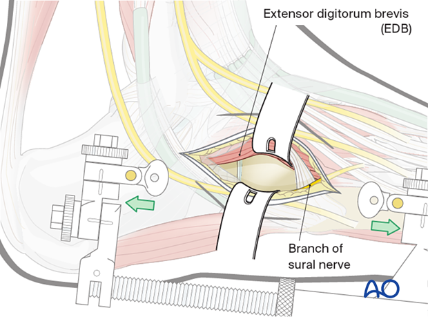 Dorsolateral approach to the cuboid