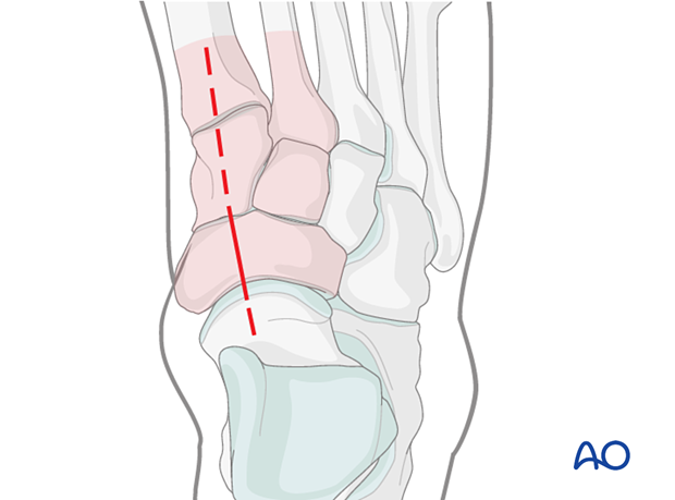 Dorsomedial approach to the navicular and cuneiform