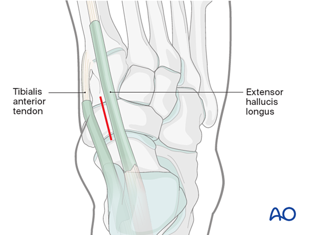 Skin incision in a dorsomedial approach to the navicular