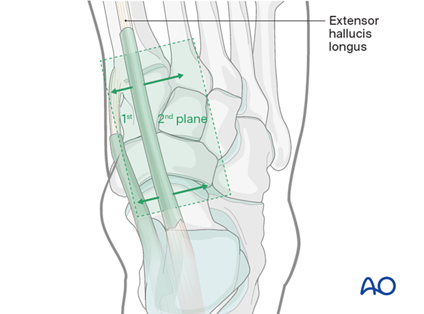 Dorsomedial approach to the navicular and cuneiform