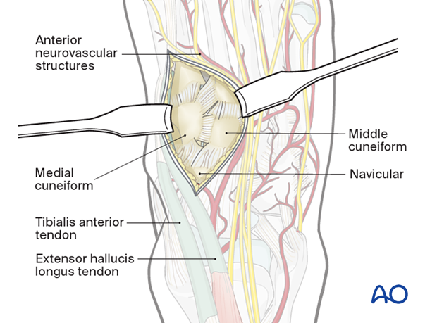 Exposure of 1st and 2nd metatarsal joint and middle cuneiform with a dorsomedial approach