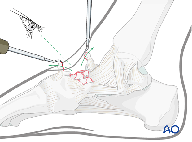 TMT joint visualization