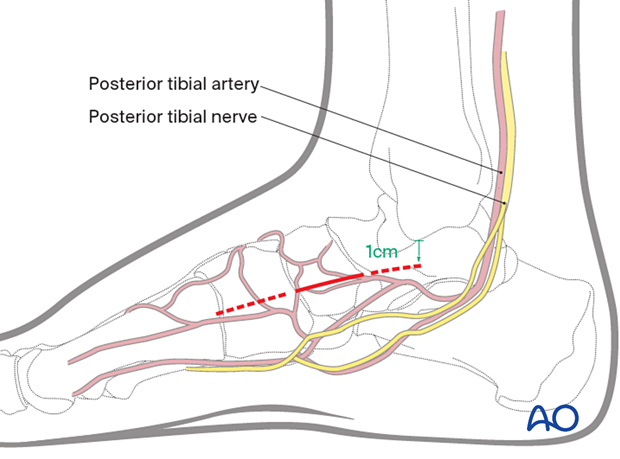 Skin incision for a medial utility incision to the navicular