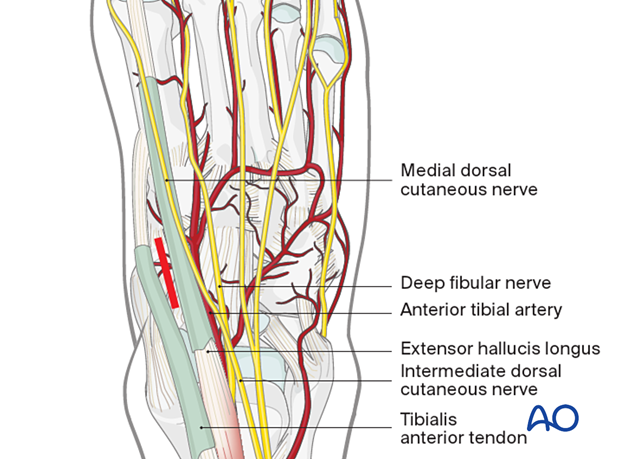 Skin incision for the percutaneous approach to the navicular