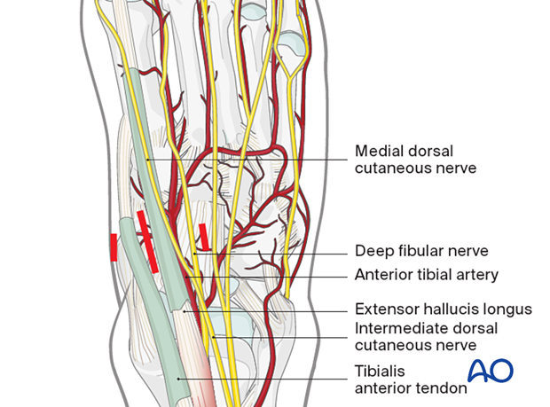 Percutaneous approach to the navicular