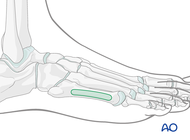 Percutaneous approach to the navicular