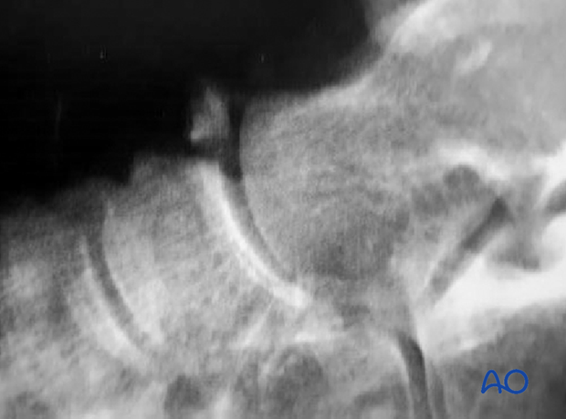 CT image showing a small avulsion fracture of the navicular from the “constant fragment”