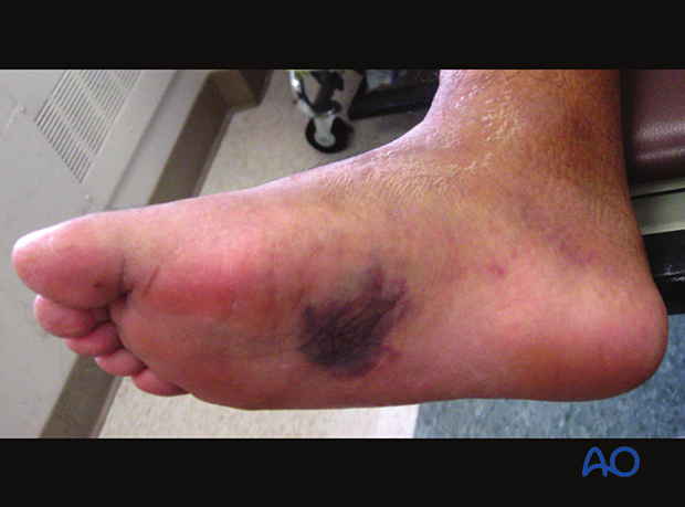 Plantar ecchymosis indicating bony or ligamentous midfoot injury