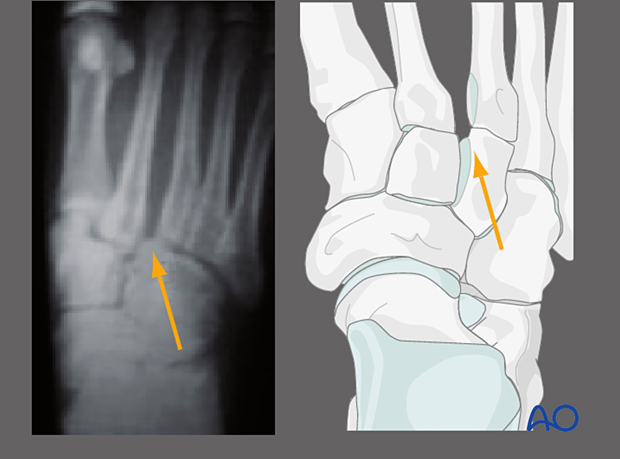 Malalignment at the medial border of intermediate cuneiform and the 2nd metatarsal