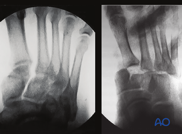 Intraoperative stress view (right image)