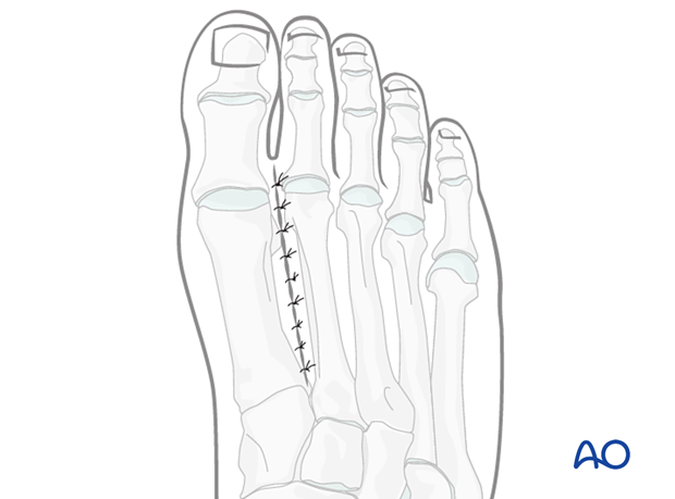 Wound closure of the incision made between the 1st and 2nd metatarsal