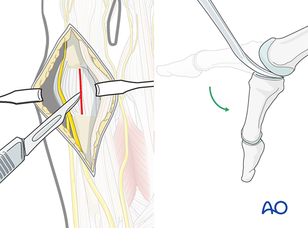 Joint capsule incision of the dorsal approach to the first metatarsal