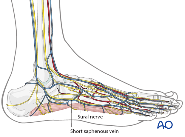 Important relevant anatomical structures when approaching the fifth metatarsal from laterally