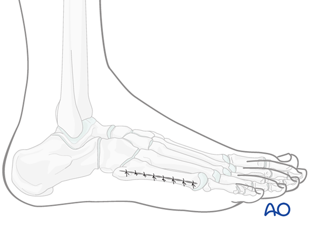 Wound closure of the lateral approach to the fifth metatarsal