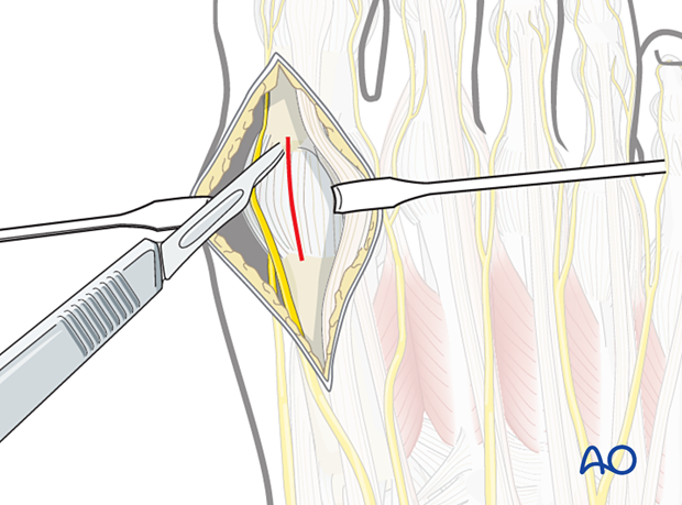 Entering the articular capsule