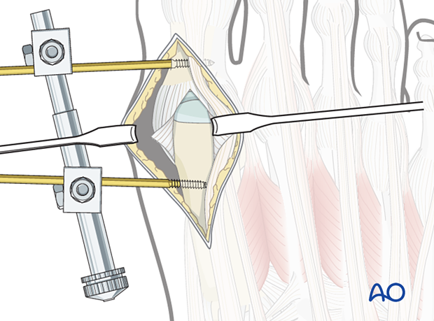 A010 dorsal approach to the first metatarsal phalangeal joint mtpj