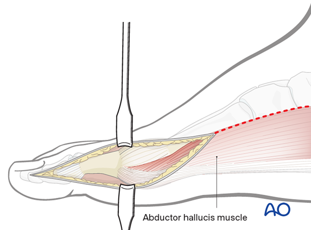 Extension of the approach