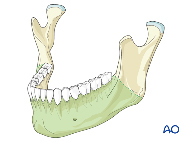 The transoral approach is the usual access for simple fractures of the body, symphysis, and angle regions.