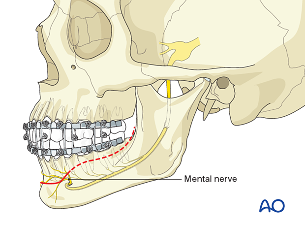 The course of the mental nerve vs the incision line