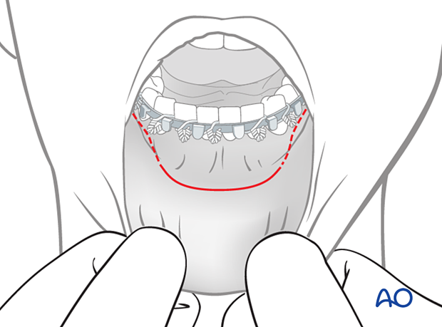 The incision is made through the mucosa in the vestibule