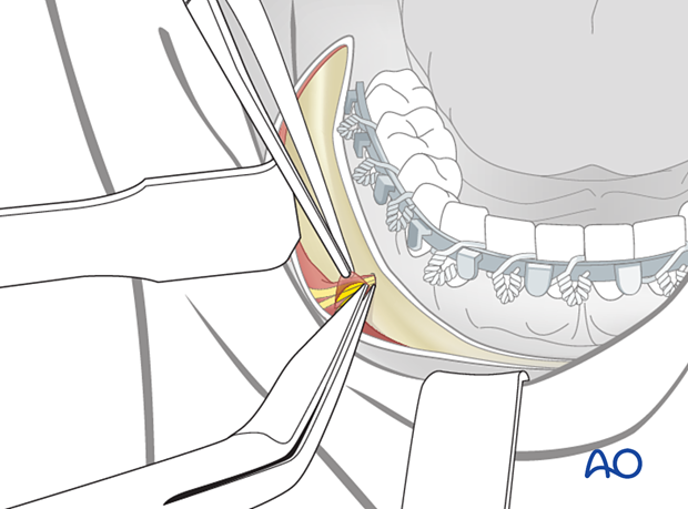 Skeletonization of the mental nerve