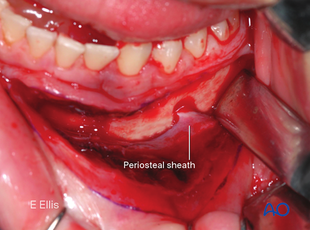 Mental foramen and mental nerve exposed