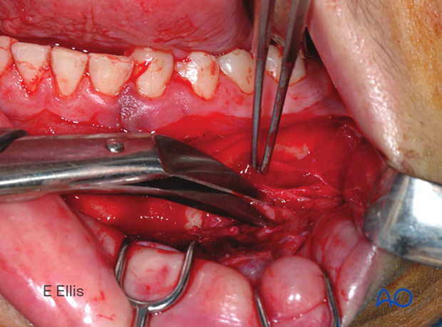 Spreading scissors parallel to nerve to release the soft-tissue envelope