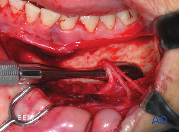 Skeletonization of the mental nerve.