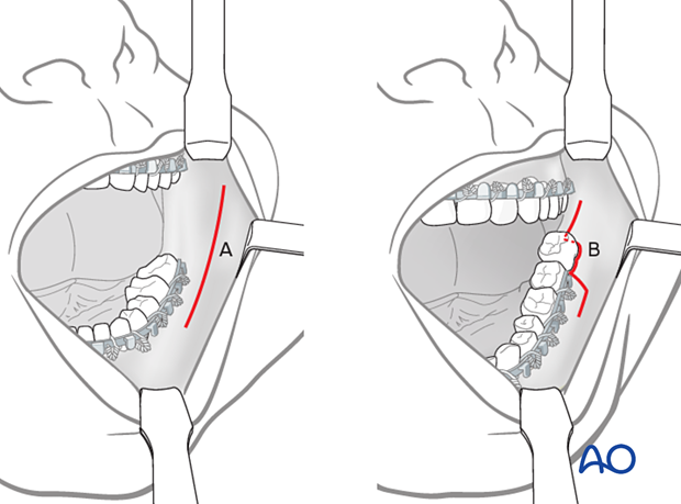 approach to the le fort i level of the midface in cleft lip and palate patients