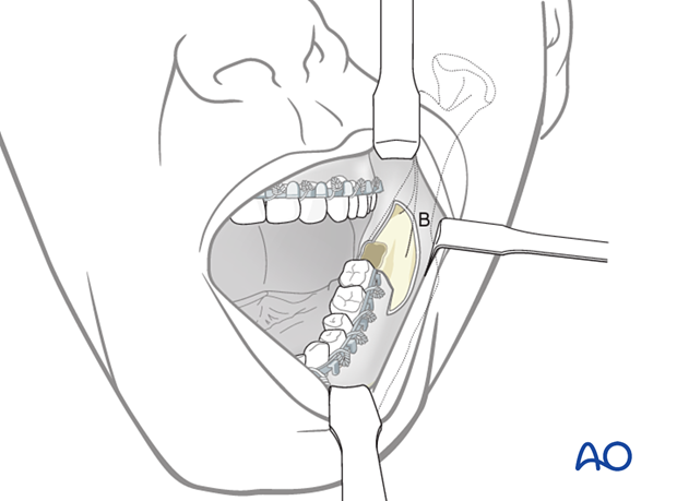 91 A011 transoral approach to the angle