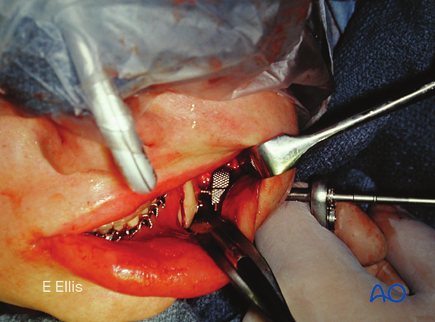 Transbuccal instrumentation