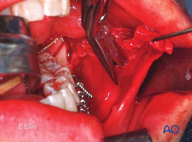 Scoring of the periosteum