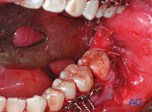 Clinical picture of final closure