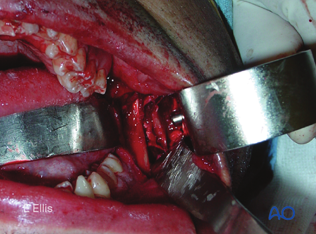 Clinical example of the transbuccal trocar instrumentation