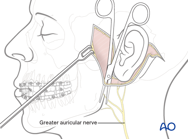 A skin flap is elevated in the subcutaneous plane