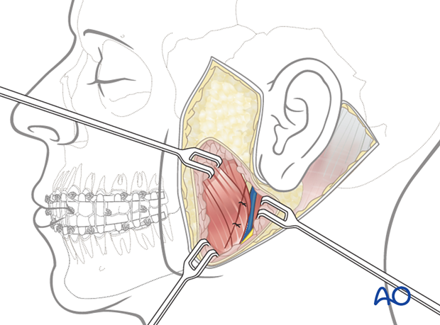 The pterygomasseteric sling is reapproximated with sutures