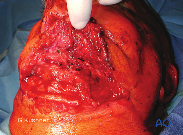 Underlying mandibular fracture