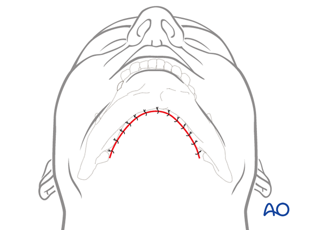 91 A050 submental approach