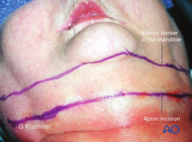 The inferior border of the mandible is marked along with the planned skin incision