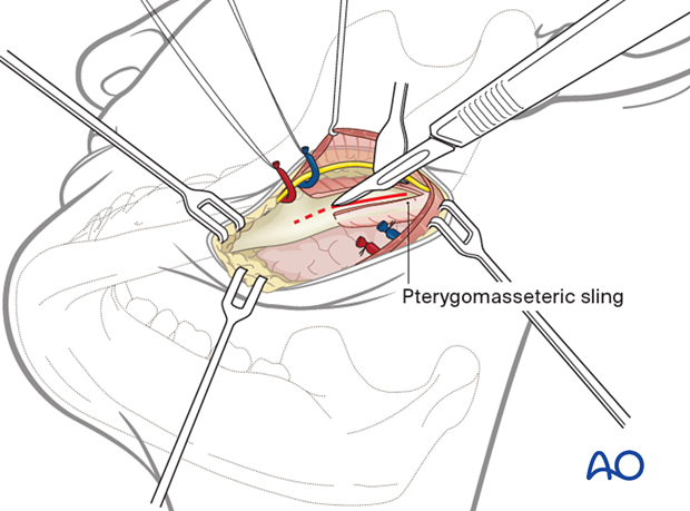 approach to the le fort i level of the midface in cleft lip and palate patients