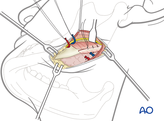 During wound closure, the pterygomasseteric sling is repaired.