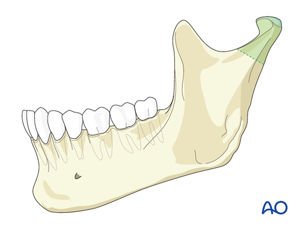 Exposure offerend by the preauricular approach