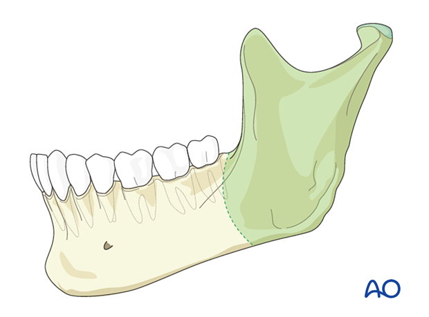 Facelift incision (rhytidectomy)